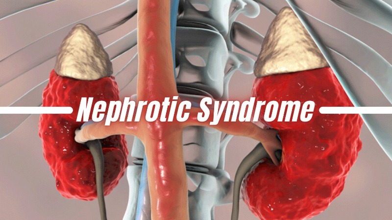Ayurvedic Medicine For Nephrotic Syndrome