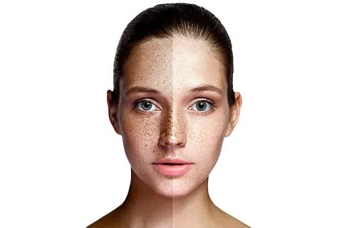 skin pigmentation treatment