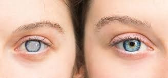Best Glaucoma Surgeon in Madurai